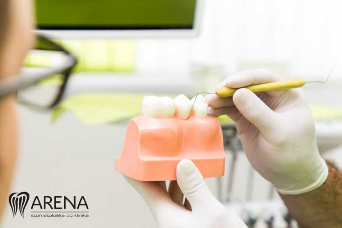 Prikaz upale zubnog mesa na modelu.