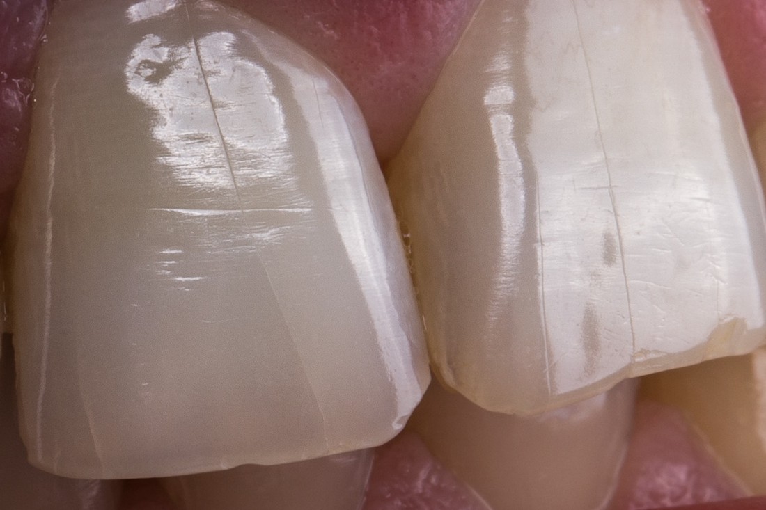 Velika pukotina na površini zuba.