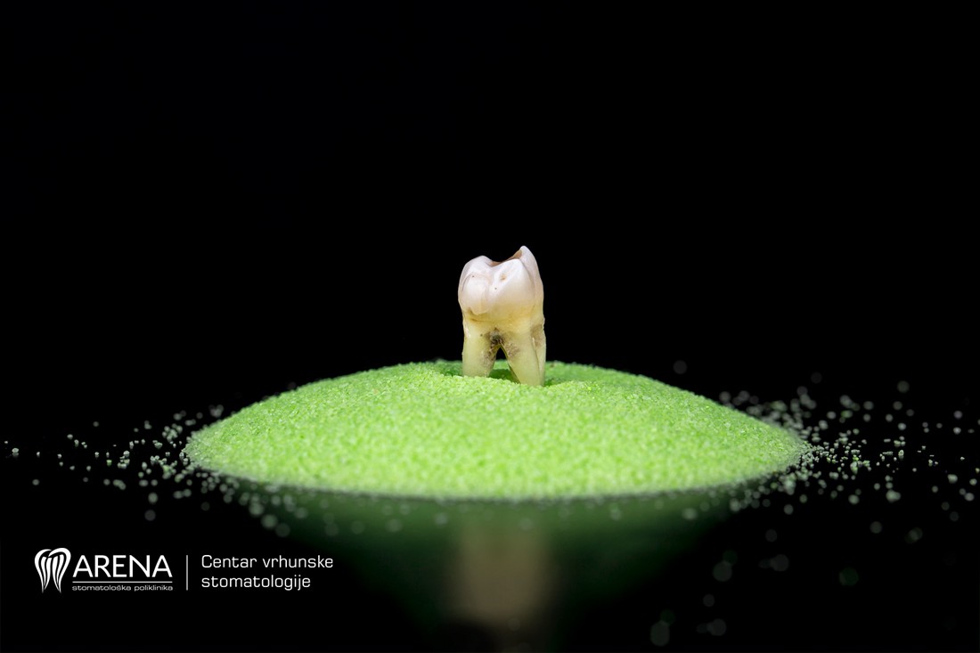 Zubni karijes na zubu.