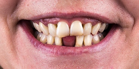 Slučaj 3: Prije ugradnje cirkon keramičkih krunica