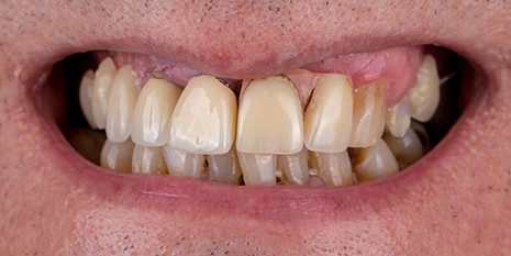 Slučaj 1: Prije ugradnje metal keramičkih krunica