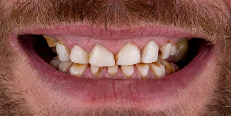 Slučaj 2: Prije ugradnje metal keramičkih krunica