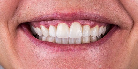 Slučaj 3: Nakon ugradnje cirkon keramičkih krunica