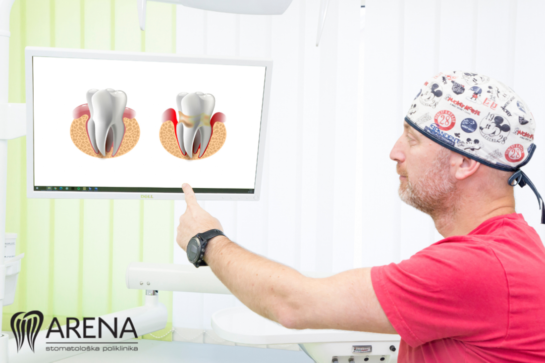 Simptomi parodontitisa