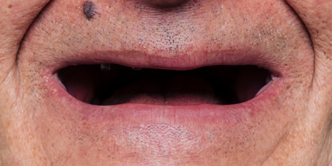 Case 1: Before the ALL-ON-4 Method