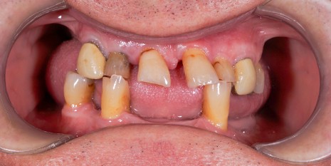 Slučaj 4: Prije ugradnje cirkularnog mosta i cirkonskih krunica