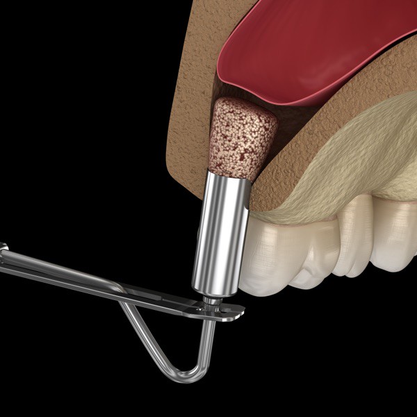 Medicinski precizna 3D ilustracija sinus lifta (podizanje sinusa)