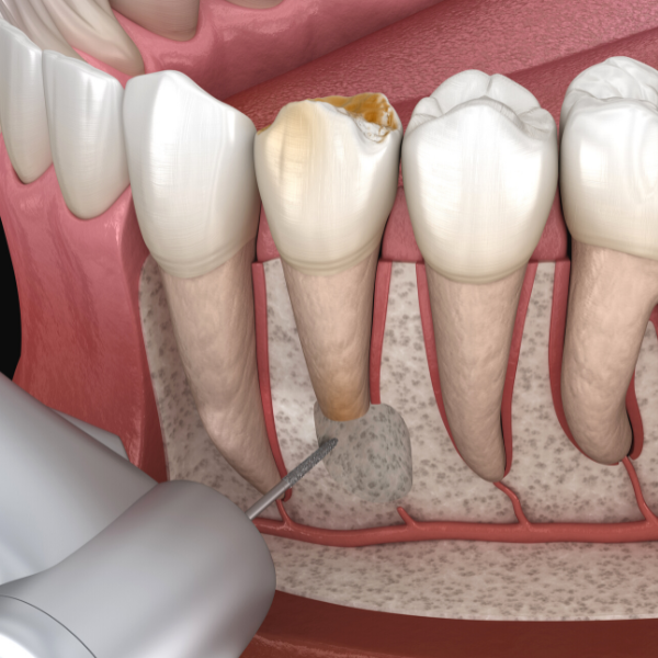 Medicinski precizna 3D ilustracija apikotomije (uklanjanje vrha korijena zuba)