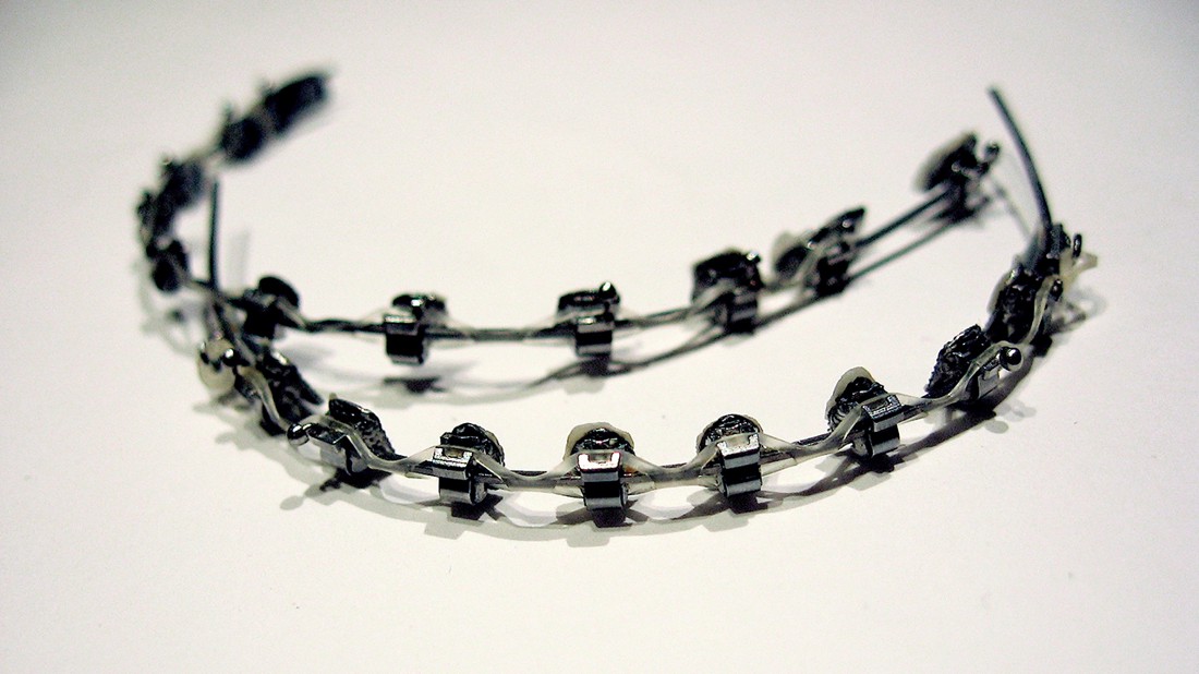 Fiksni aparatić s metalnim bravicama.