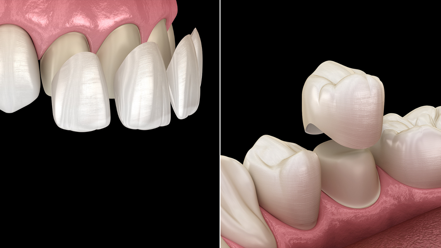 Corone, faccette in ceramica e in composito | Top Doctors