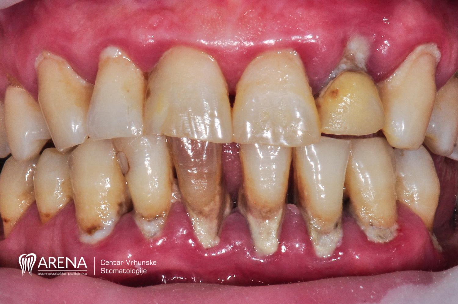 Stanje pacijentovih zuba prije zahvata u poliklinici ARENA.