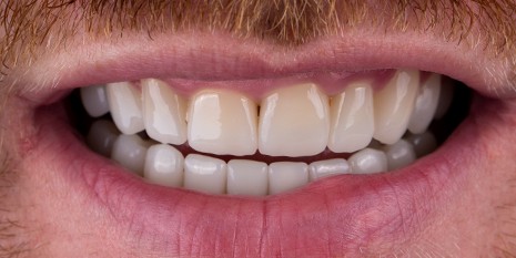 Slučaj 5: Nakon ugradnje cirkon keramičke krunice