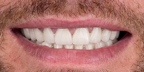 Slučaj 2: Nakon ugradnje metal keramičkih krunica