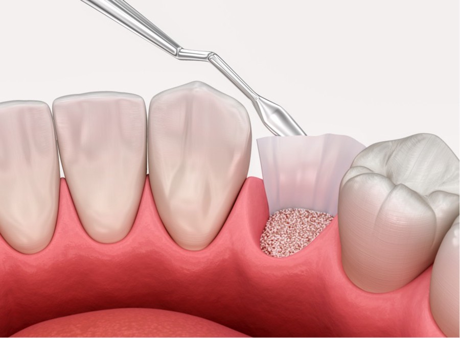 Proces nadogradnje nadogradnje umjetne kosti. Medicinski precizna 3D ilustracija nadogradnje umjetne kosti.
