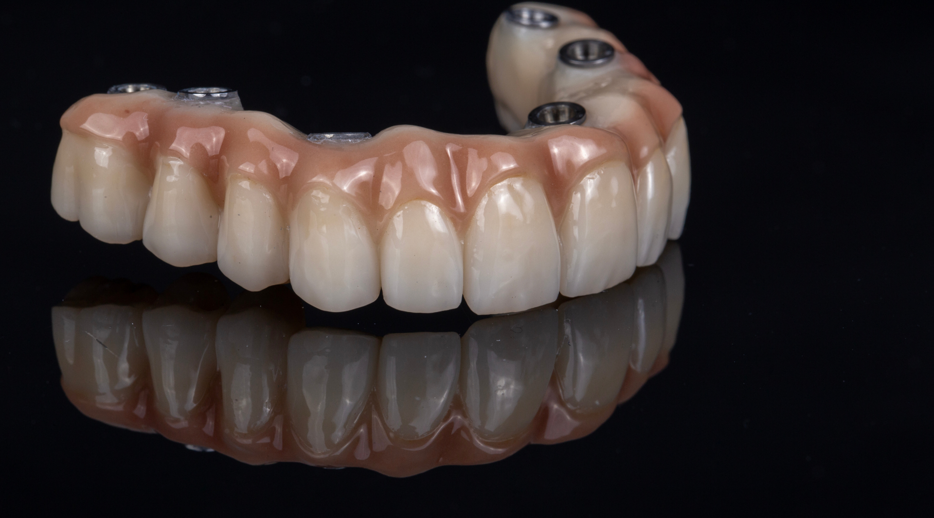 All ON 4 metoda(fiksna proteza na implantatima)