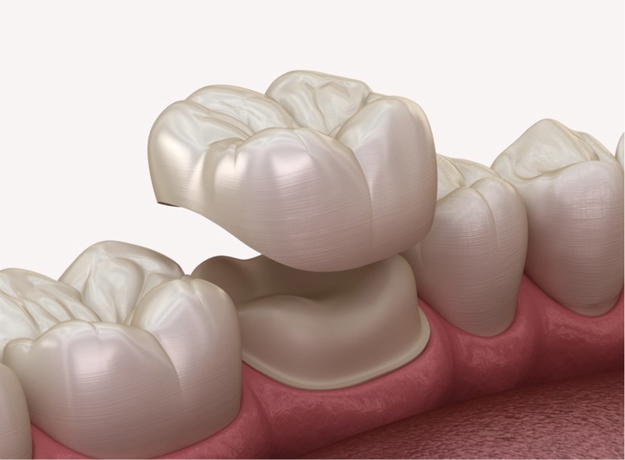Proces nadogradnje pretkutnjaka zubnom krunicom. Medicinski precizna 3D ilustracija nadogradnje zuba krunicama za zube