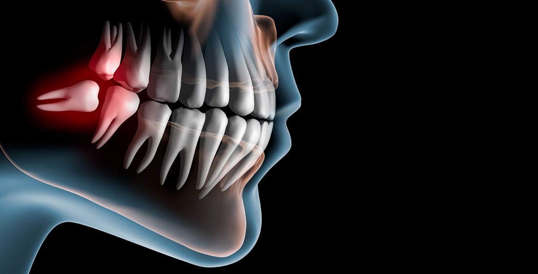 Ortopanski prikaz umnjaka koji je za vađenje - alveotomija.