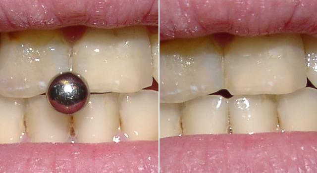 Zubi koji su oštećeni zbog konstantnog zagriza na piercing.