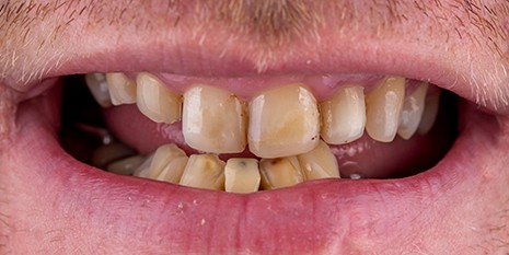 Slučaj 5: Prije ugradnje cirkon keramičke krunice