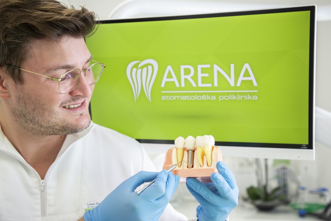 Zubni implantati – prikaz titatnskog vijka u modelu zuba.