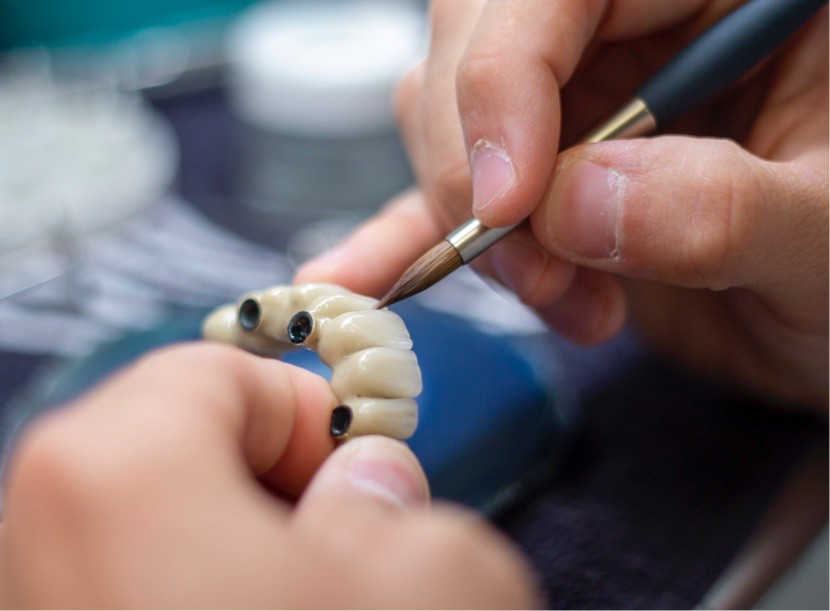 Ručna dorada fiksne proteze ALL ON 4