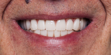 Case 2: A New Smile After Placement