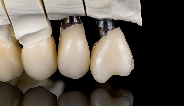 model-zubni-implantat