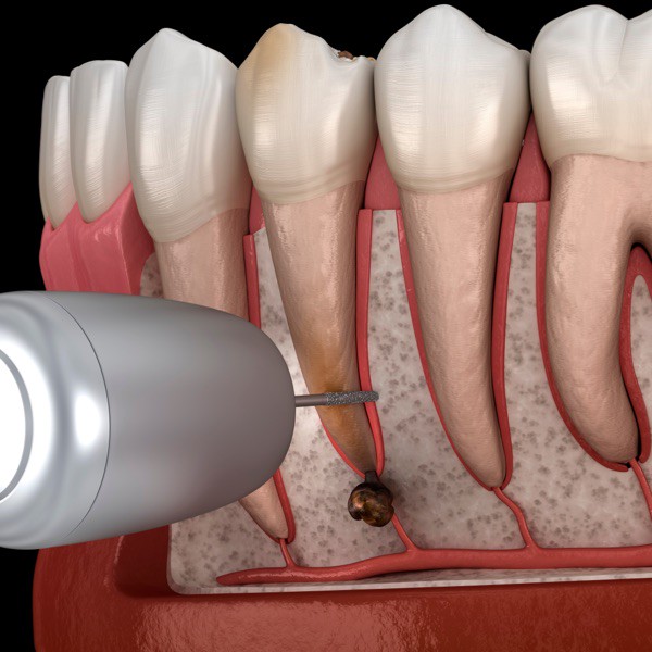 Medicinski precizna 3D ilustracija cistektomije (uklanjanje cističnog sadržaja)