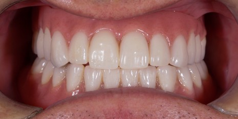 Slučaj 4: Nakon ugradnje cirkularnog mosta i cirkonskih krunica