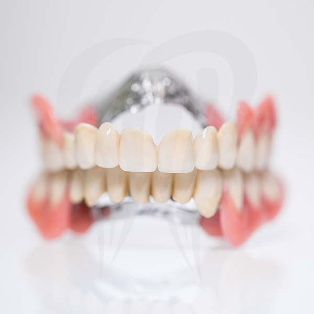 Djelomična proteza koja se pričvršćuje za preostale zube.