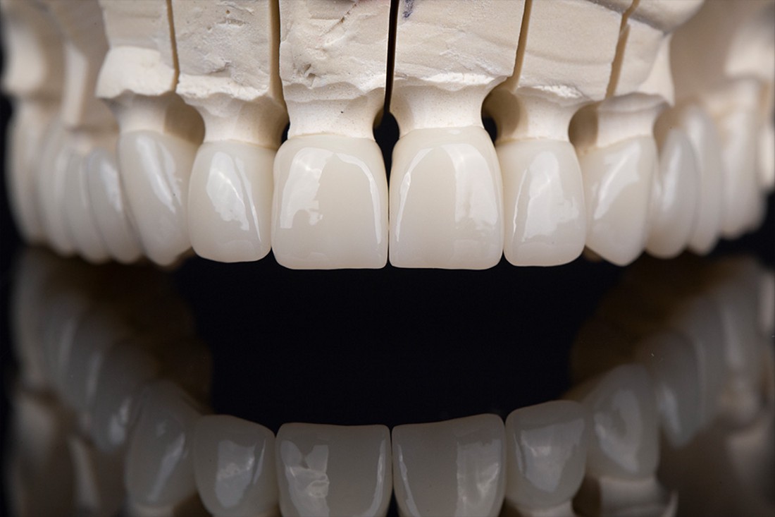 Zubne krunice protetski su nadomjestak za ljepotu i funkcionalost zubima.