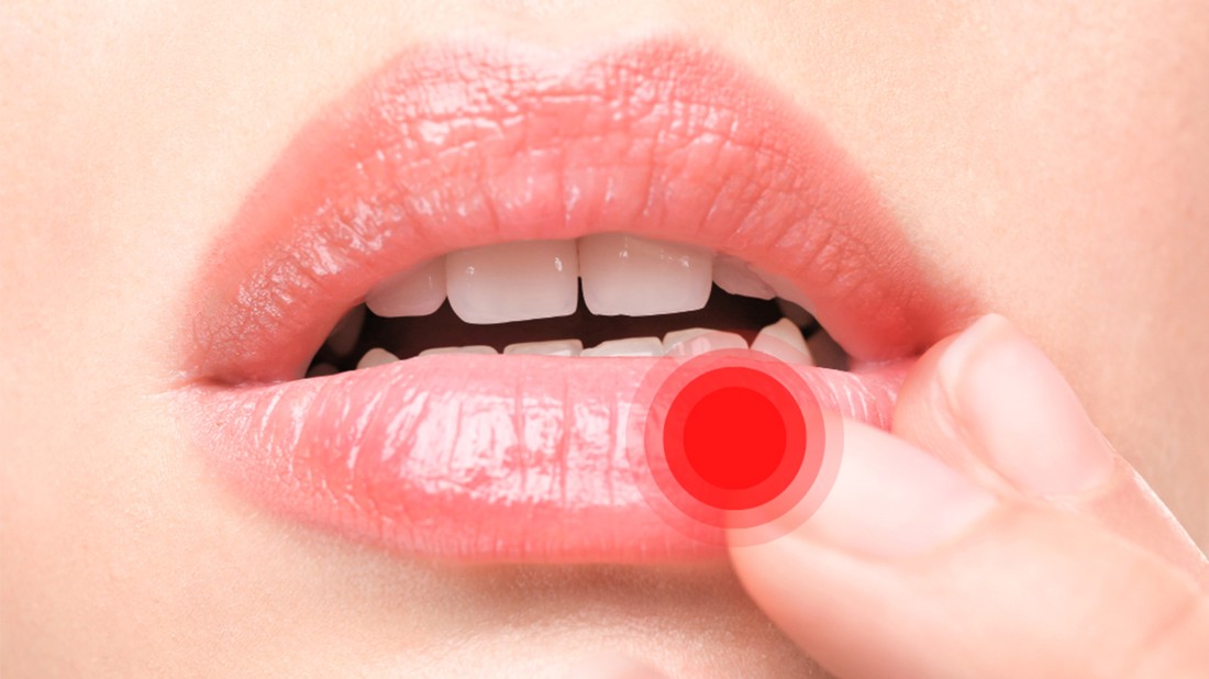 Afte male bolne ranice.