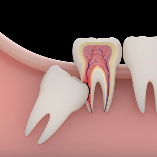Medicinski precizna 3D ilustracija alveotomije (vađenje umnjaka)