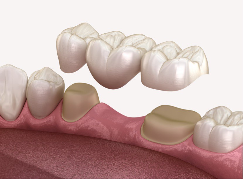 Medicinski precizna 3D ilustracija izrade zubnih mostova