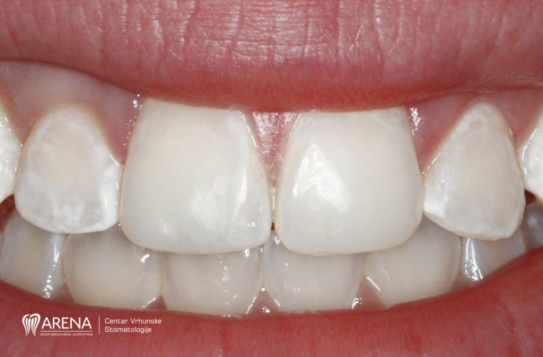 Zubi na kojima se vide bijele mrlje,