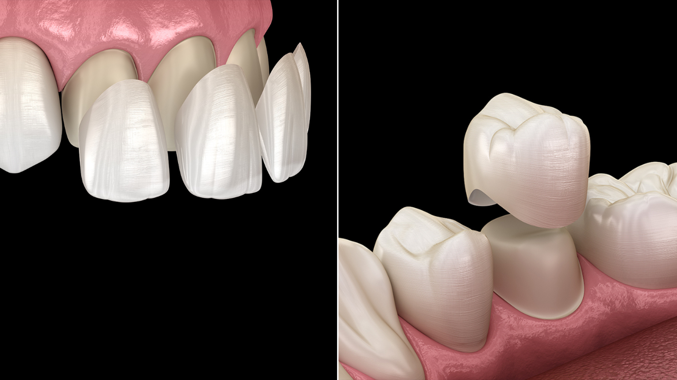 Veneers en facings verschillen en voordelen