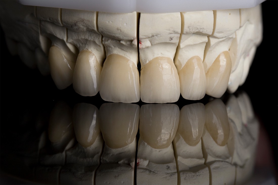 Potpune cirkonske zubne krunice na modelu.