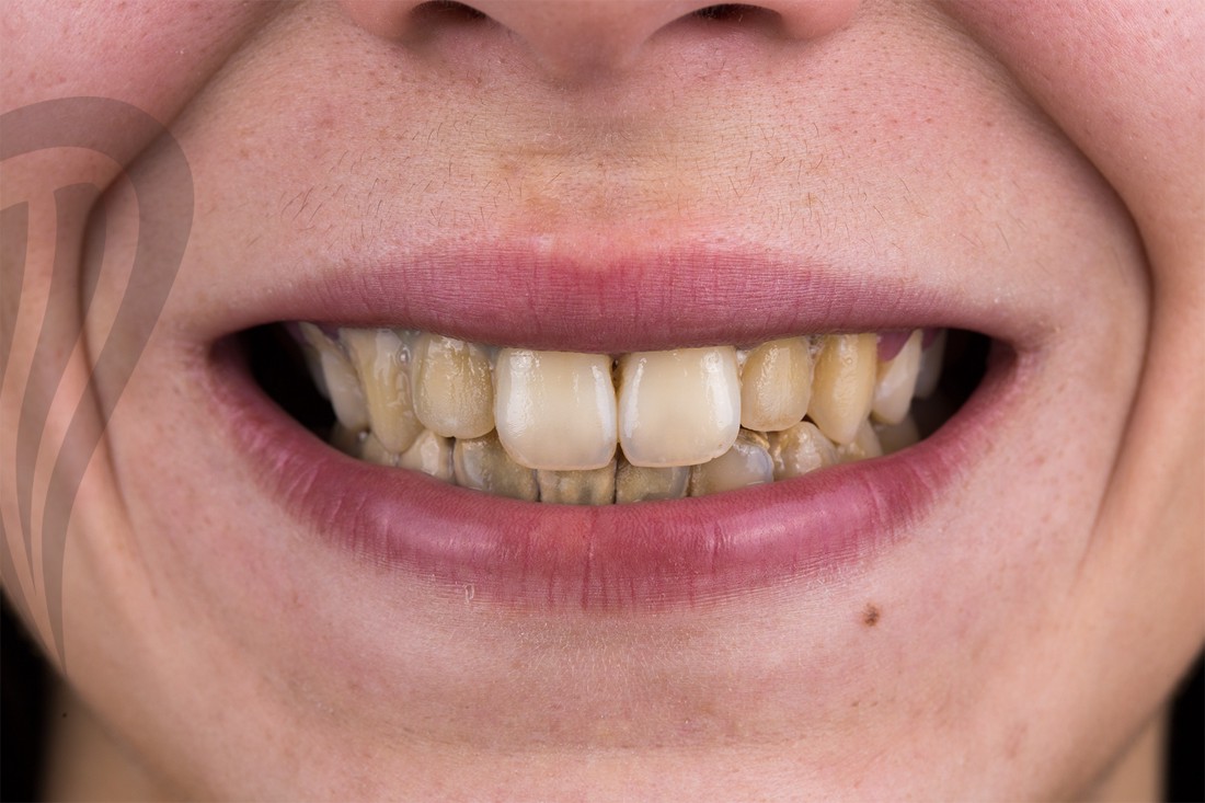 Zubni kamenac na pacijentovim zubima