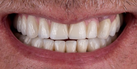 Slučaj 1: Nakon ugradnje metal keramičkih krunica