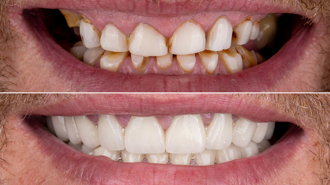 Zubne krunice riješenje za novi osmijeh.