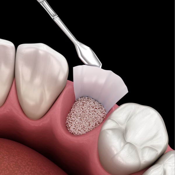Medicinski precizna 3D ilustracija augmentacije (ugradnja umjetne kosti)