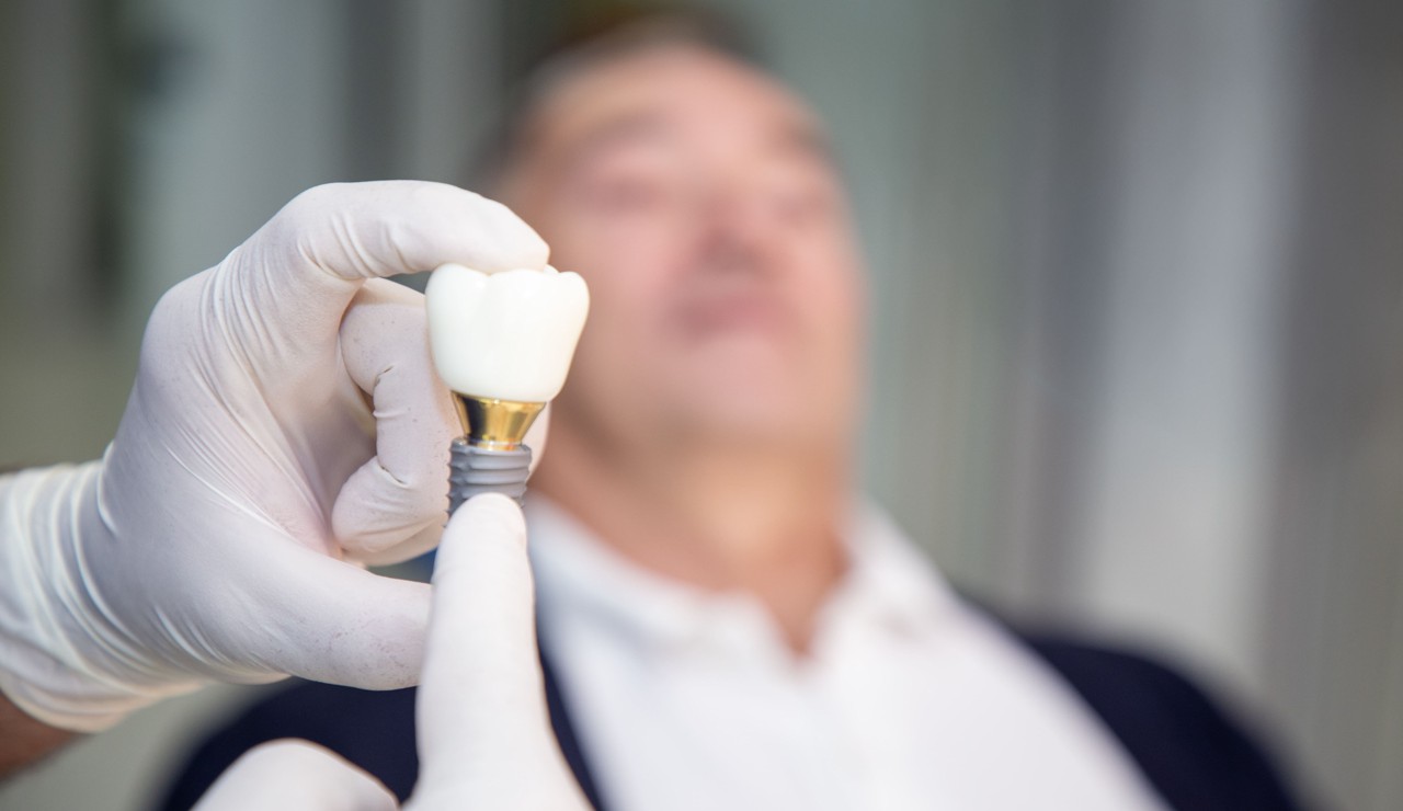 Što stoji iza cijene zubnih implantata_1