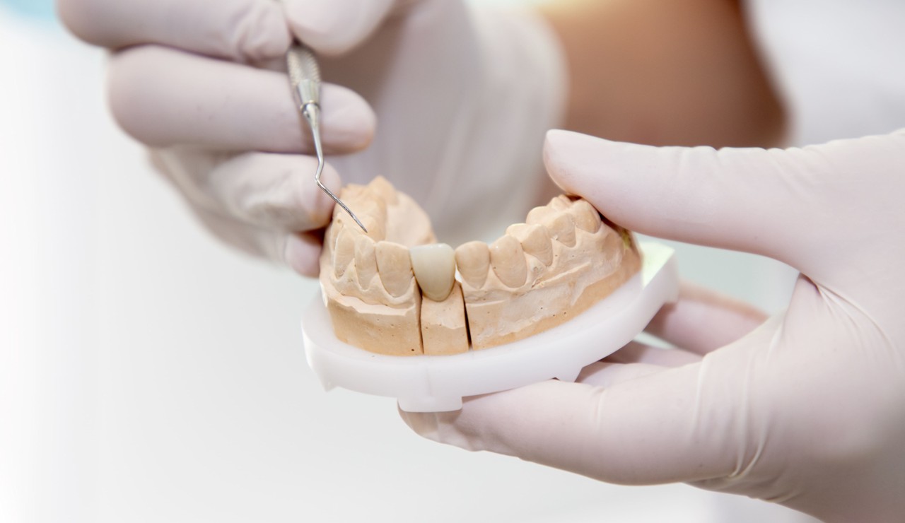 Zubne krunice - blog - 1