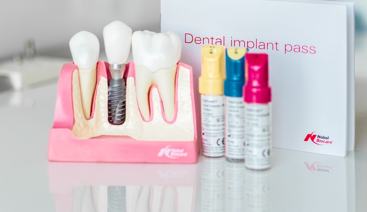 The Ultimate Guide to Dental Implants: What You Need to Know