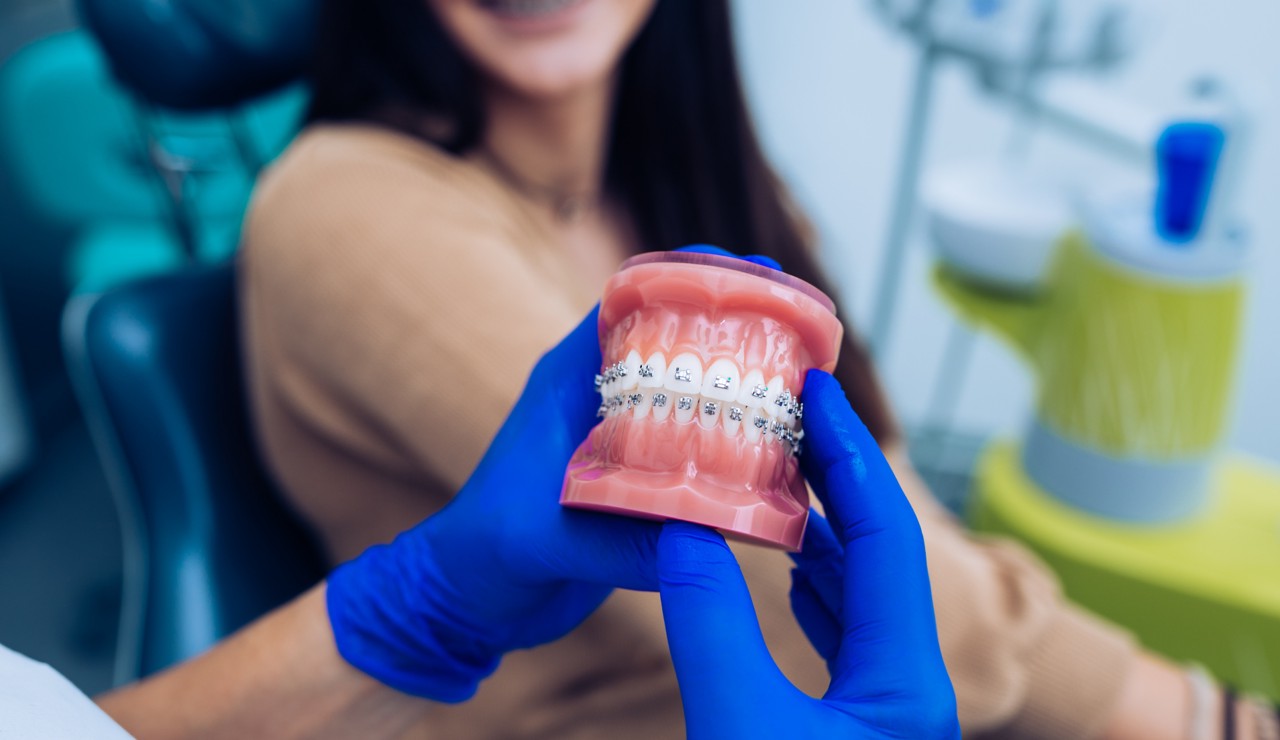 Fiksna ortodoncija_full