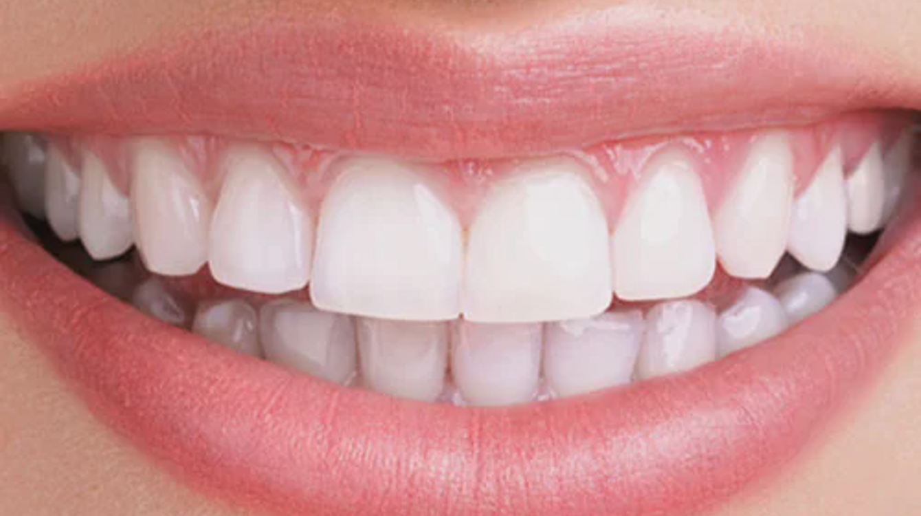 teeth-whitening-blogimg.jpg