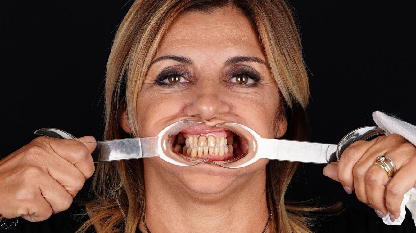 Portret pacijentice prije implantološke terapije i ugradnje cirkonskih krunica, s vidljivim gubitkom zubi i potrebom za estetskom i funkcionalnom rekonstrukcijom.