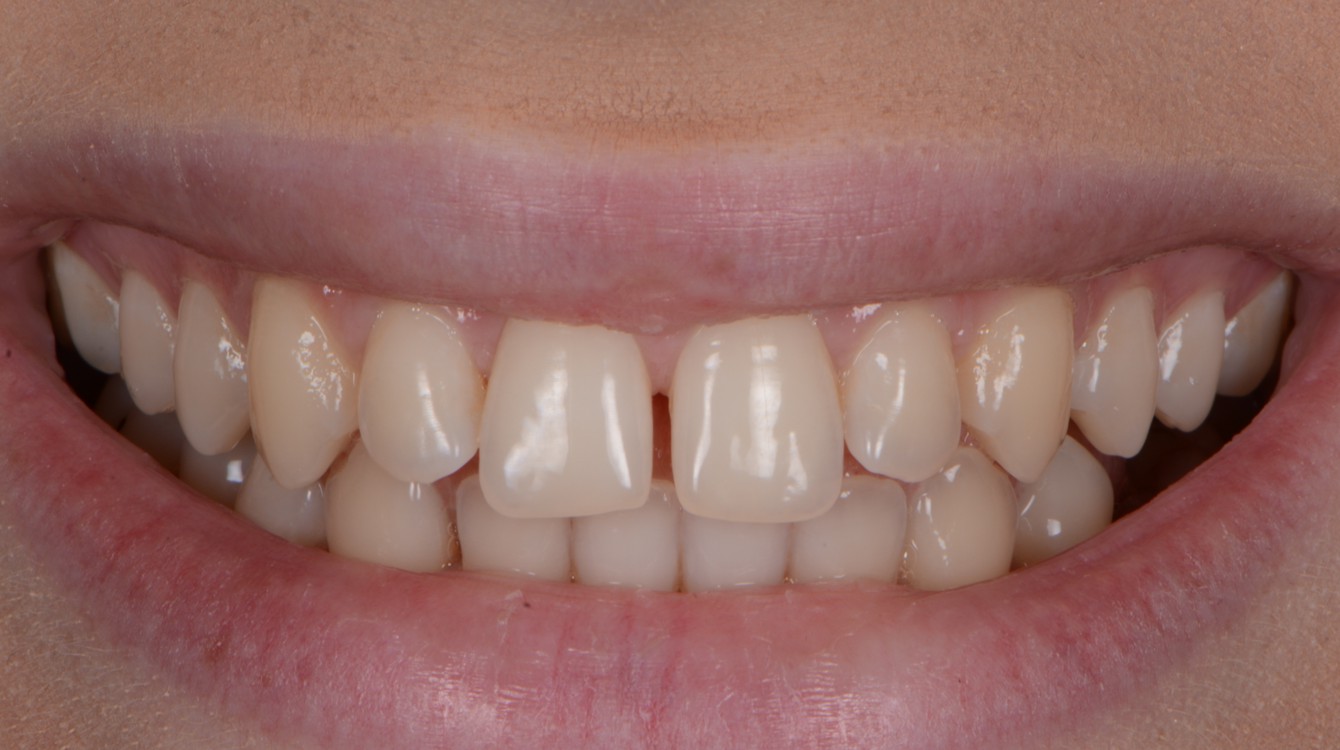 makeover_2_andrea_teeth_before