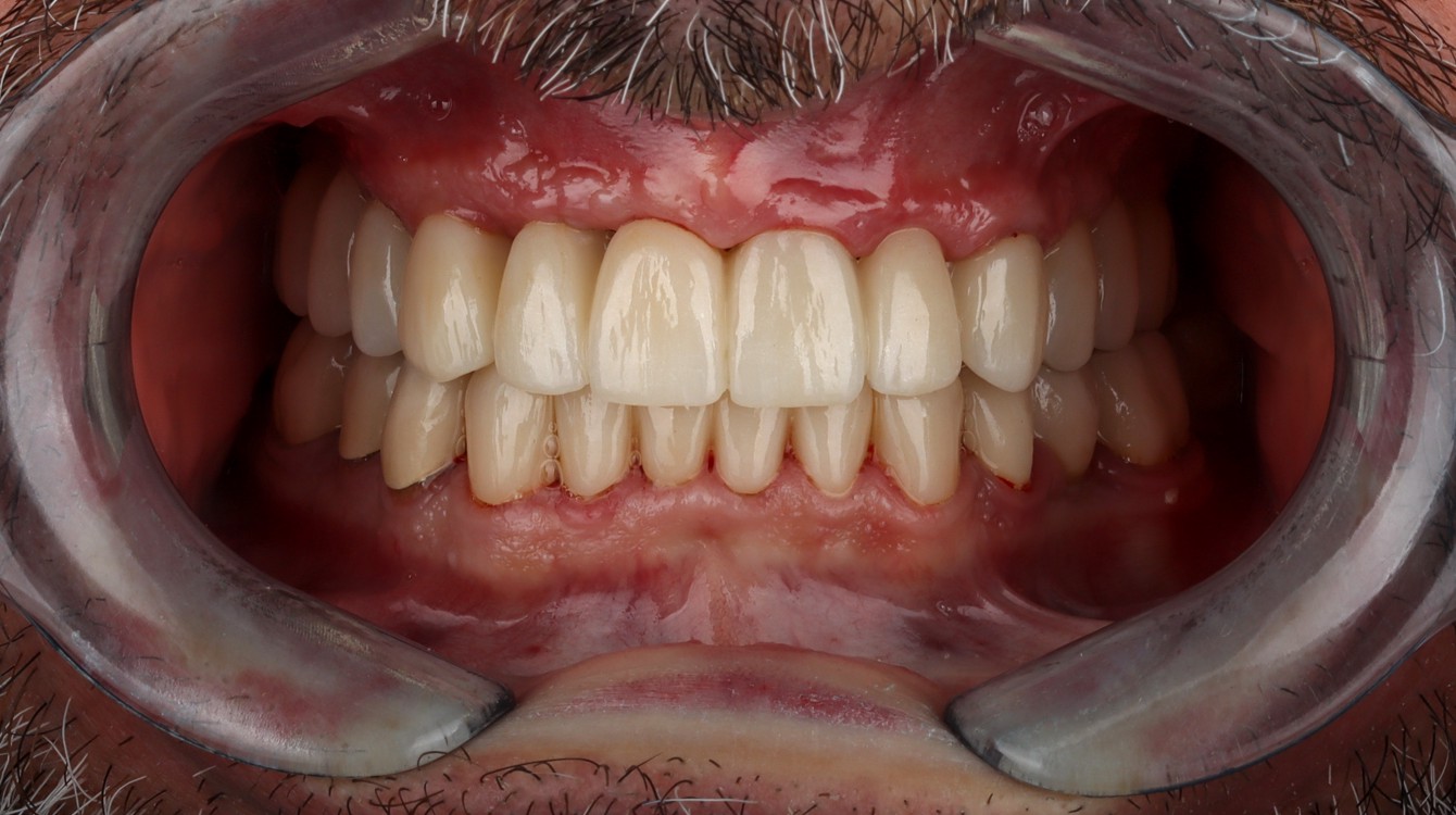Intraoralna slika pacijenta nakon implantološke terapije i ugradnje cirkonskih krunica, s precizno oblikovanim i estetski usklađenim zubima.