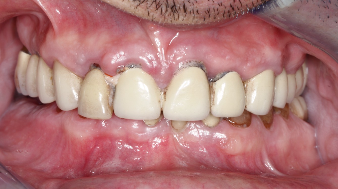 Intraoralna slika pacijentice prije funkcionalno-estetske rehabilitacije s implanto-protetskom terapijom, prikazuje postojeća oštećenja i nedostatke u oralnom zdravlju.